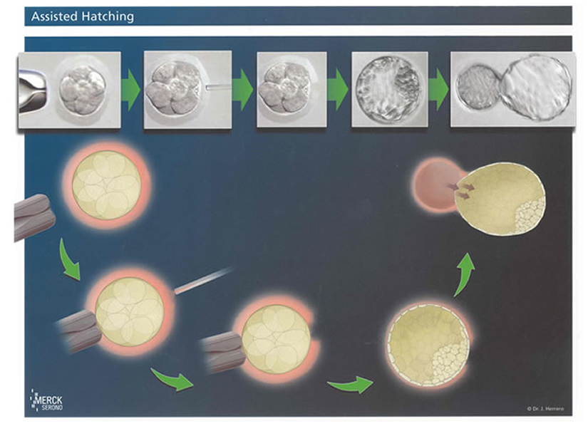 In Vitro Fertilisation - IVF - Kinderwunsch praxis Bochum, Dortmund